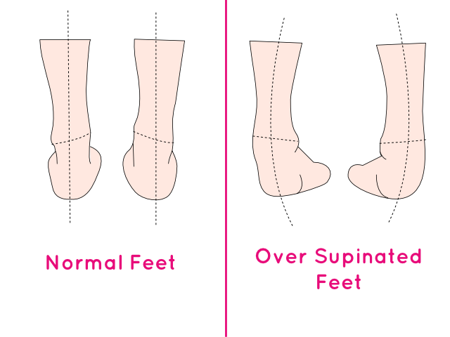 over-supination