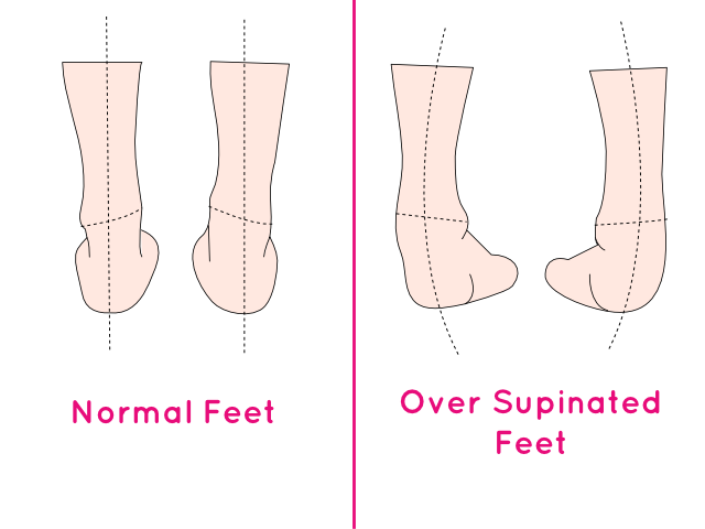 Supination of Foot and Oversupination